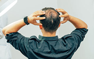 血糖失控会掉发 2方法有助逆转秃头
