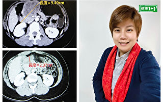 10公分癌瘤竟自动缩小至2公分？她分享抗癌6秘笈