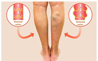 静脉曲张可致栓塞命危 1动作促血液回流 中医4招改善