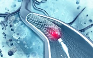 血管成形术和心脏支架的风险与好处