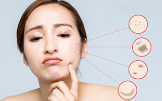 脸上斑点成因很多 中医师教你对症祛斑