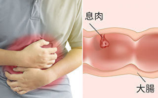 大肠息肉会癌变 专家: 护肠防癌必吃2类食物