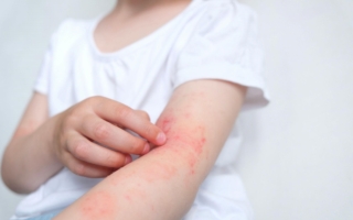 五原因致湿疹 一饮食就让它消失 原因何在？