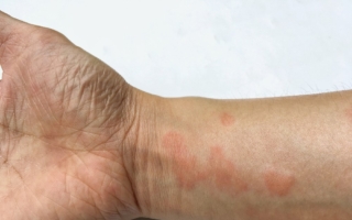 红斑狼疮是不死癌症？揭秘诱因及自救指南