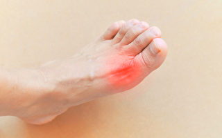 五种方法舒缓痛风 简单有效且无副作用