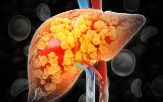 肝脏和胰脏悄悄变油 这样做可消减内脏脂肪