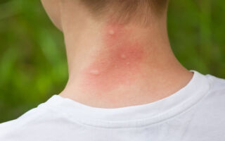 被蚊子叮咬如何止痒？ 简单10招快学起来