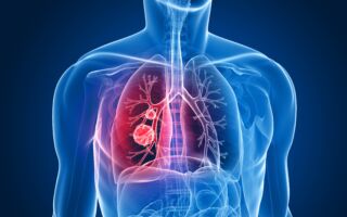 注意！如果你的手有这种症状 你可能罹患肺癌