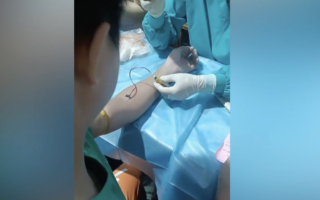 广东基孔肯雅热发现迟致大爆发 累计病例近万