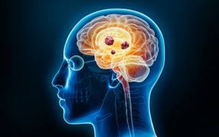 7个容易被忽略的脑瘤征兆 看看你有没有