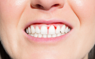 医生：牙龈出血可能代表身体缺少某种物质