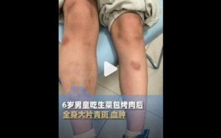 深圳男童吃生菜后全身血肿 检出钩虫感染